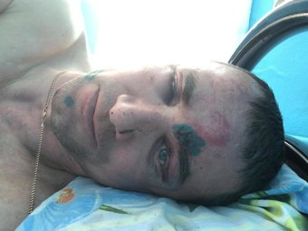 Избитый на Шиесе рабочий. Ему пресловутые эко-активисты не дают покоя даже в больнице.
